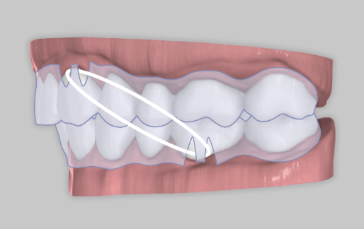 Aligner with elastic slits