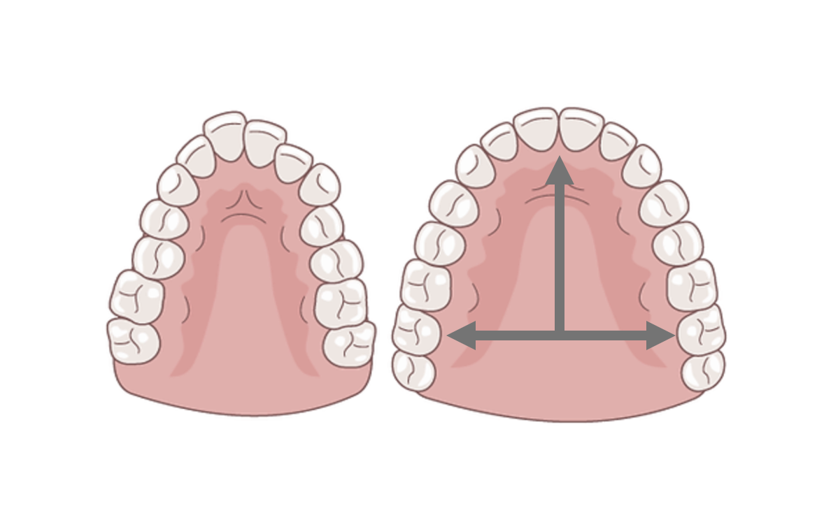 Forward and wider dental arches